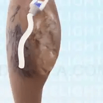 Treat Varicosveins