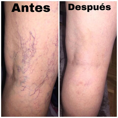Treat Varicosveins